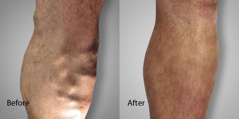 Varicose Vein Before & After male Dr. Ronald Lev