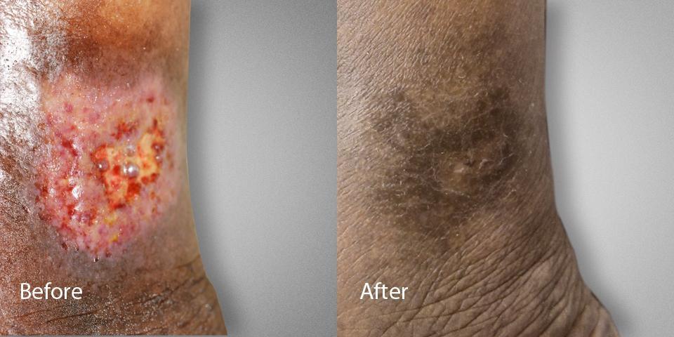 Ulcer Before & After Female Dr. Ronald Lev