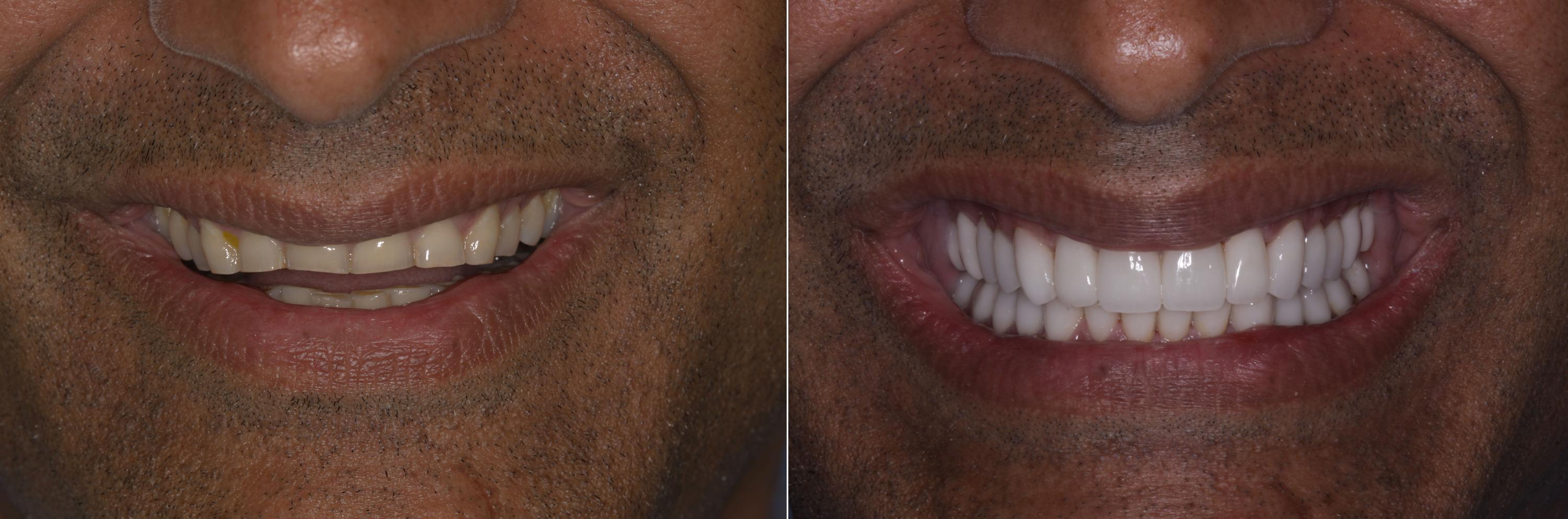 Porcelain Veneers