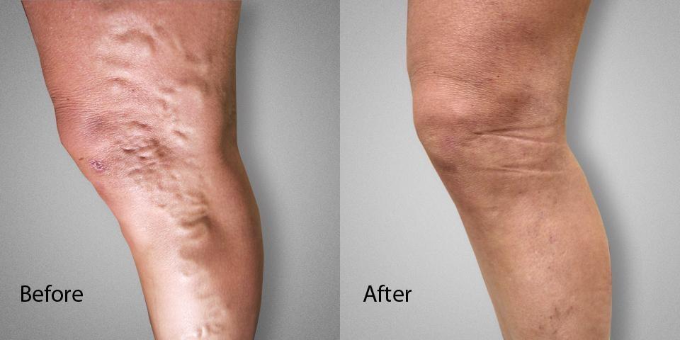 Varicose Vein Before & After Female Dr. Ronald Lev