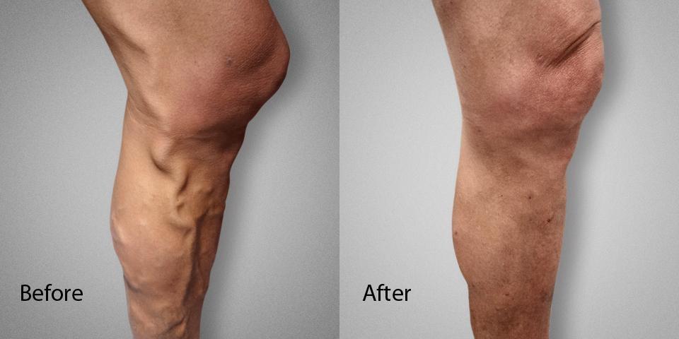 Varicose Vein Before & After male Dr. Ronald Lev