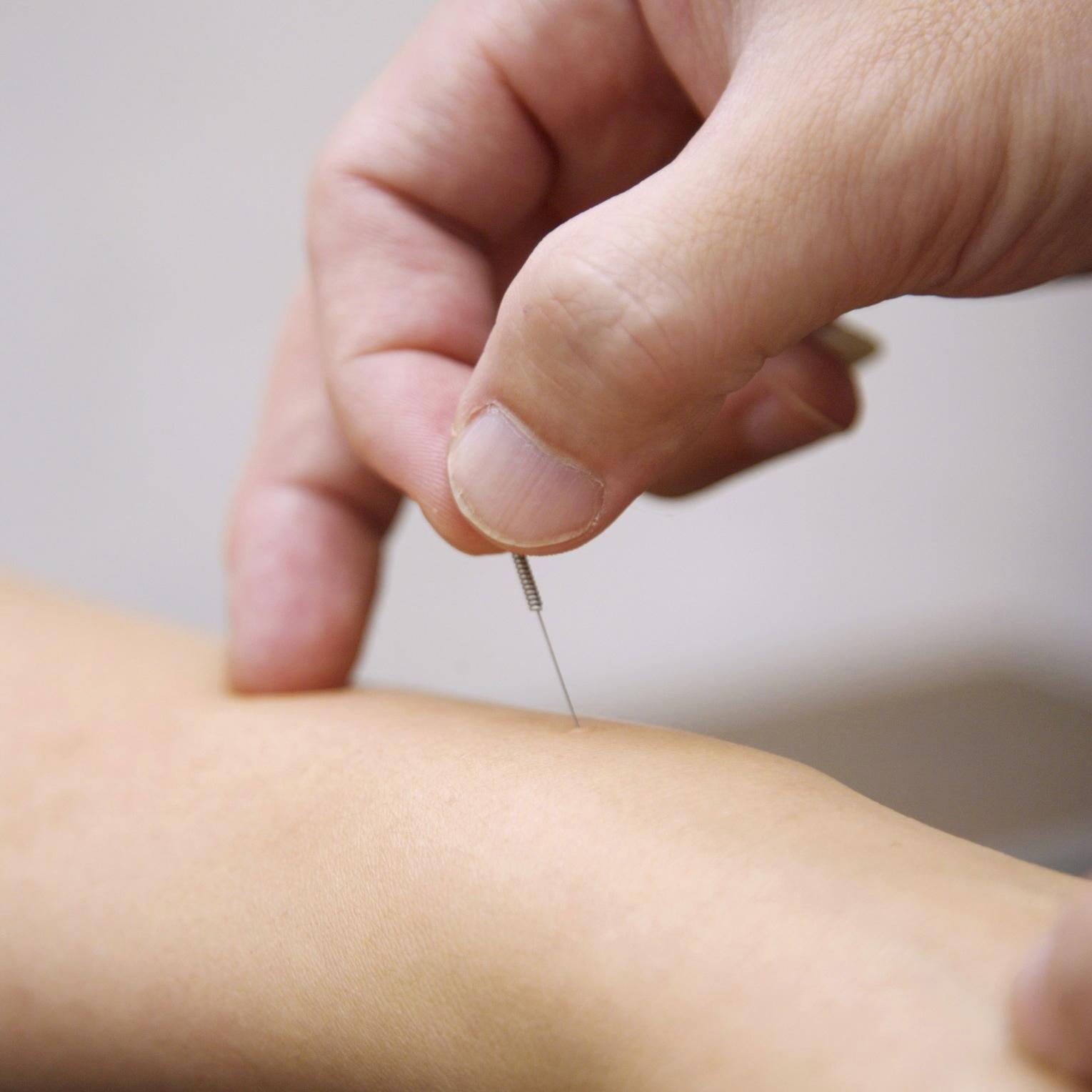 acupuncture in fort lauderdale