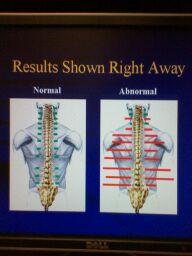 Surface EMG test show results right away