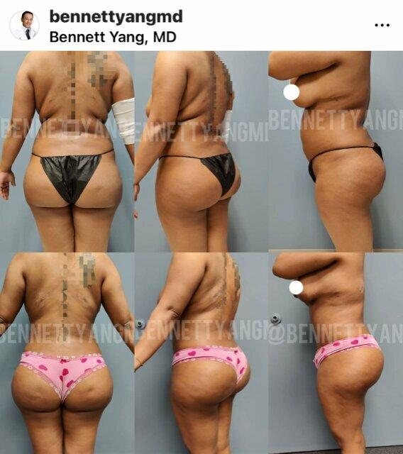 Bennett C Yang, MD-Advanced Plastic Surgery