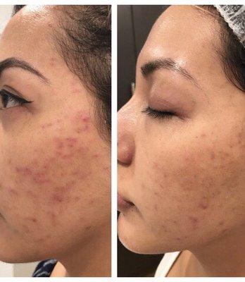 After 1 treatment (my side with less acne )