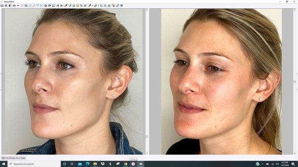 After 2 PRP facials - more even skin tone and collagen