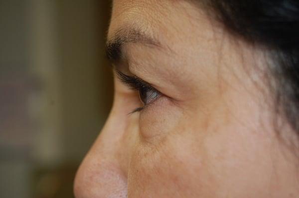 Before Upper & Lower Blepharoplasty (Eyelids)