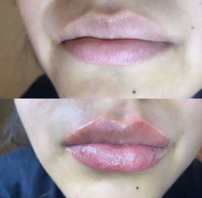 Lip Fillers