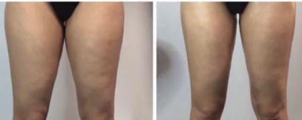 Before and After Cellulite Reduction Treatment