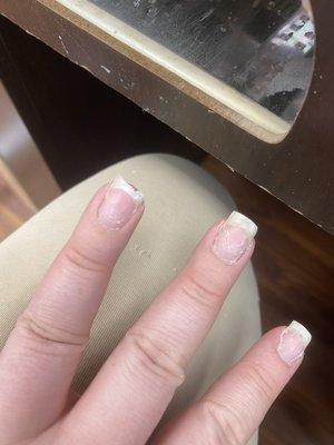 Ring finger disintegrated nail