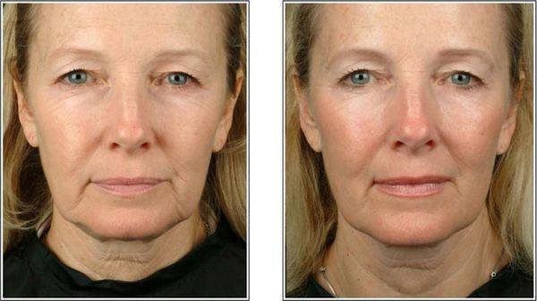 non surgical facelift using radiofrequency and ultrasound