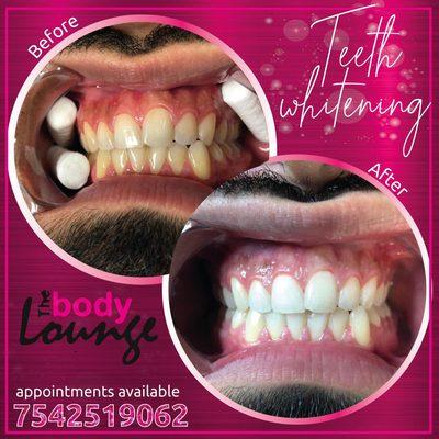 Teeth whitening