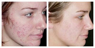 Photofacial to reduce Acne