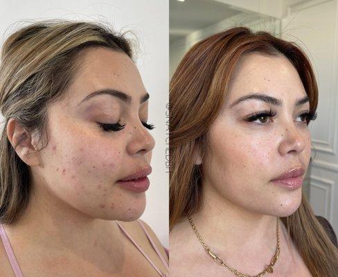 Skin rejuvenation-- snatched regimen