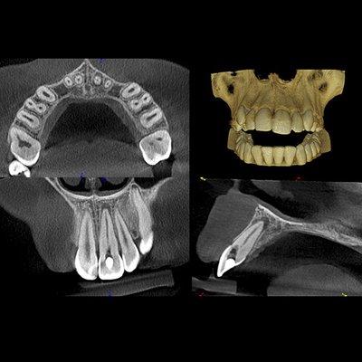 Advance Technology-3D Scan in our office for Dental Implant Planning