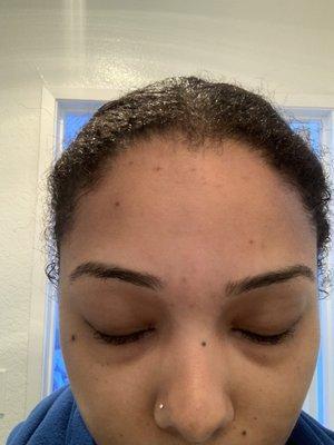 Heavy forehead scarring 2 days later. Got worse on Day 3, and didn't go away until Day 7.