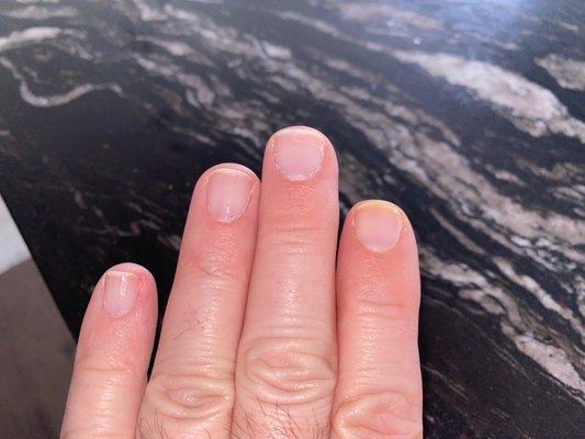 Discolored fingernail after this lady did my manicure (ugh!)