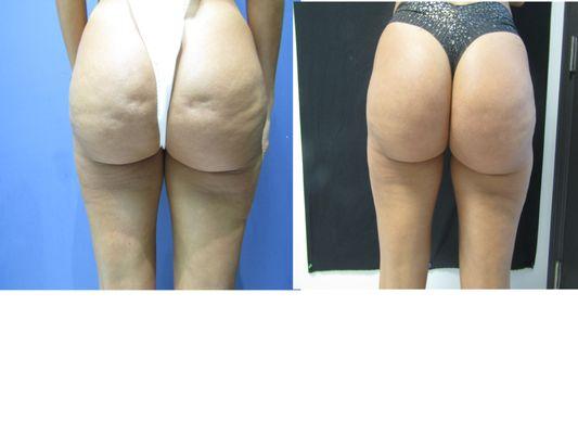 Cellfina, the best treatment for cellulite.