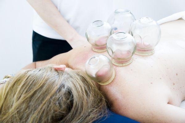 Cupping Therapy