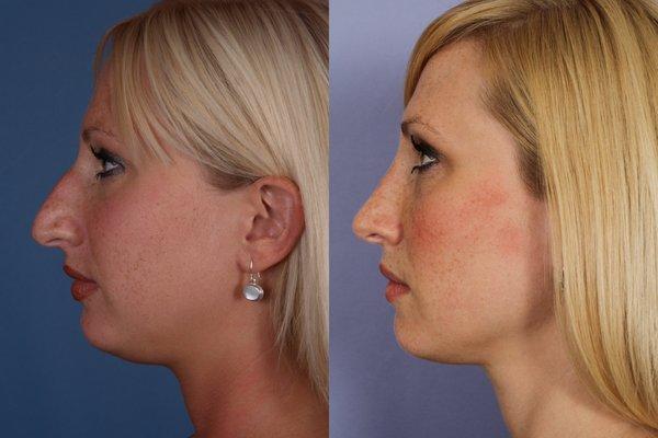 Rhinoplasty (Nose Job) Chin Implant