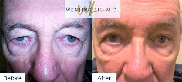 Upper eyelid lift (blepharoplasty)