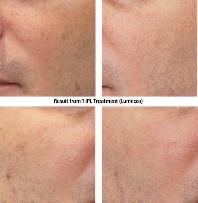 IPL treatment for sunspots