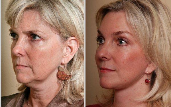 Refresher Lift with Neck Lift & Brow Lift