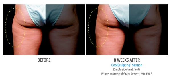 CoolSculpting Rochester Outter Thighs