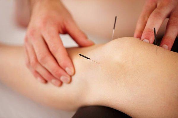 Sports Acupuncture