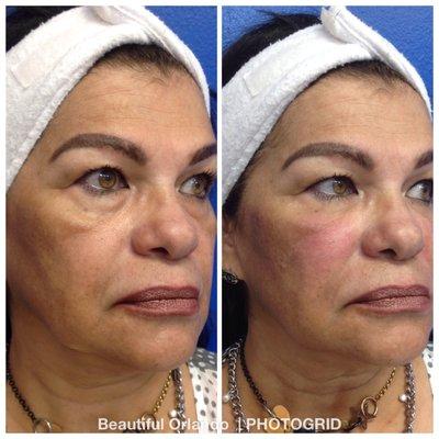 PRP with Hayluronic Acid before and after