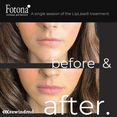 Achieve the perfect pout with our non-invasive Liplase® treatment at RewindMD!