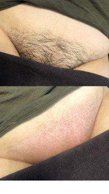 Before and after Brazilian wax