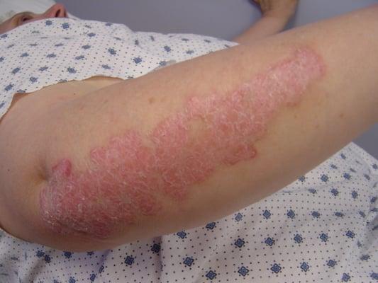 Psoriasis: before