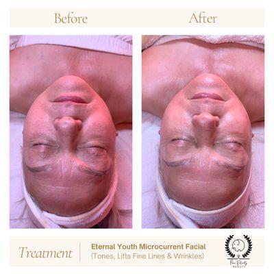 'Better than Botox' Non Invasive Treatment