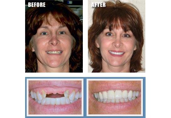 Dental Crowns and Dental  Implants