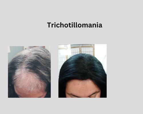 Tichotillomania more than 200,000 US cases per year.