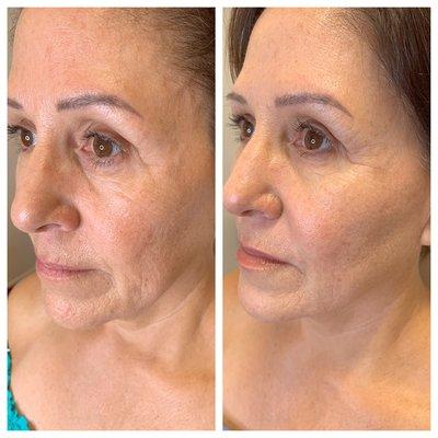 Cheek and lower face filler before and after by Dr. Selene