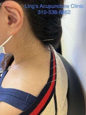 Acupuncture for neck and upper back