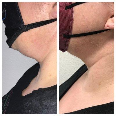 before and after Cryo neck slimming