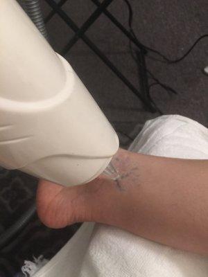 Laser tattoo removal