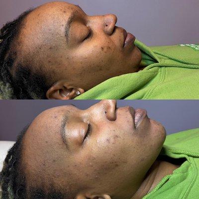 Before & After from one Chemical Peel!