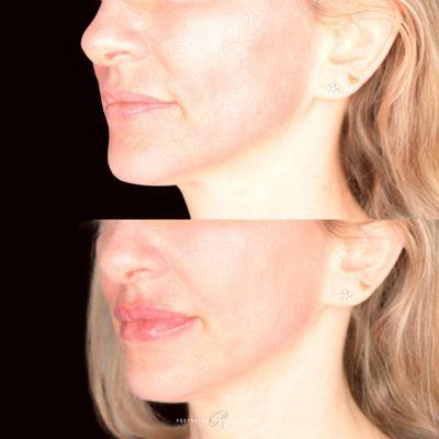 Before and After | Non-surgical Lip Augmentation