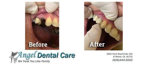 Missing a tooth? We can help. Angel Dental Care of El Monte does dental implants.