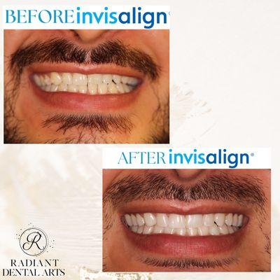 Look at those results from Invisalign! 
Call to schedule a consultation today!