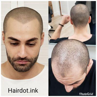 Scalp micropigmentation (SMP)