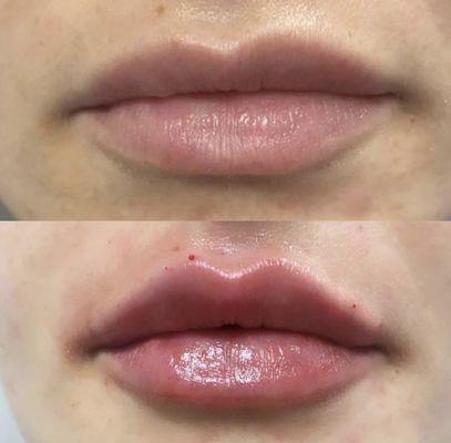 Lip Augmentation by Nurse Fay.