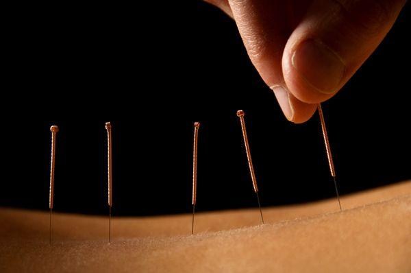 ACUPUNCTURE
 Acupressure & Chinese Herbal Medicine