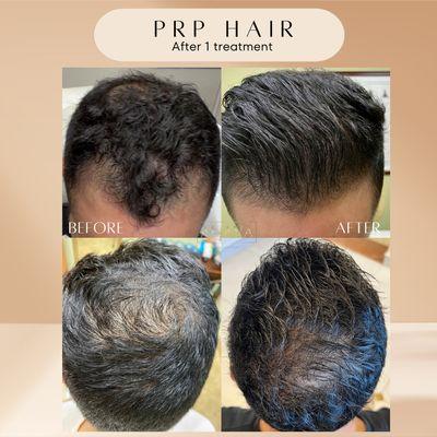 PRP injections for hair growth