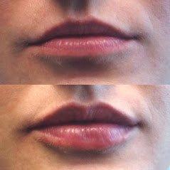 Lip Enhancement with injectable filler Juvederm