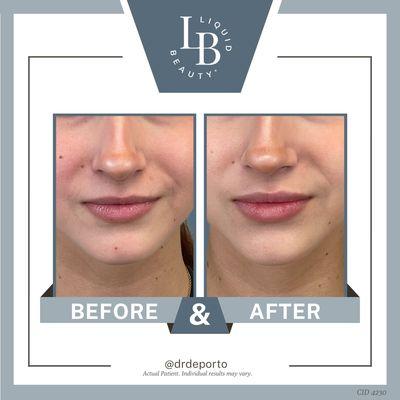 Restylane Kysse 1/2 syringe lip filler augmentation with Botox lip flip at Liquid Beauty Temecula by Dr. DePorto MD.